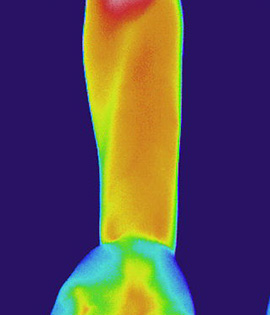 ���h�z�̘r�̃T�[���O���t�B�[�B�\�ʉ��x���������Ƃ������ԐF�ɂȂ��Ă���