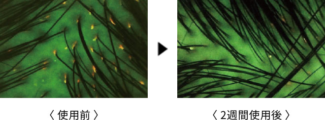 ポルフィリンが減少し頭皮の皮脂づまりが少なくなった比較写真